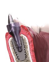 Healing screw IN-KONE®