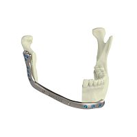 Custom-made mandibular implant non-absorbable