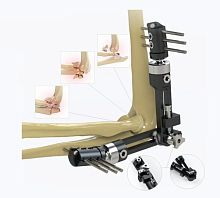 Elbow external fixation system 5934-0000tubularadult