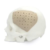 Custom-made cranial implant CranioPEEK3D 
