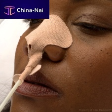 Nasogastric tube catheter fixation 160adhesive
