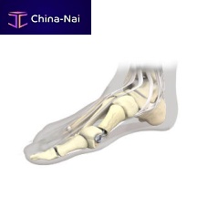Hallux valgus osteotomy screw Stoffellametatarsal bonemetatarsophalangeal jointmetallic