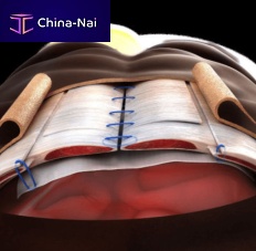 Orthopedic tissue matrix XCM Biologic