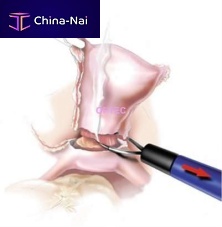 Laparoscopic electrode LapLoop wire loopmonopolar