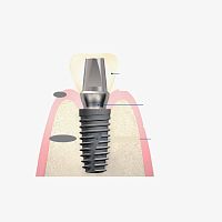 Titanium implant abutment internalstraightcemented