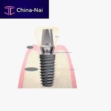 Titanium implant abutment internalstraightcemented