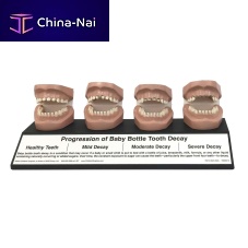 Tooth decay anatomical model 79212mouthdental carechild