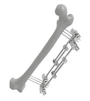 Femur external fixation system 201502tubularadult