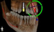 Surgery software Blue Sky Planfor dental implantology3D viewingplanning