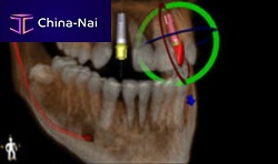 Surgery software Blue Sky Planfor dental implantology3D viewingplanning
