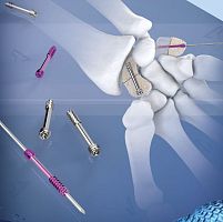 Radial head compression bone screw metacarpal jointcannulatedheadless