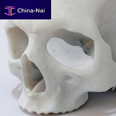 Custom-made periorbital implant TnR seriesabsorbable