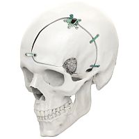 Non-absorbable cranial fixation system LeForte Neuro 0.6