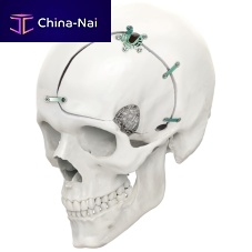 Non-absorbable cranial fixation system LeForte Neuro 0.6