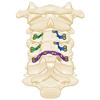 Cervical vertebra laminoplasty plate Ritavertebra