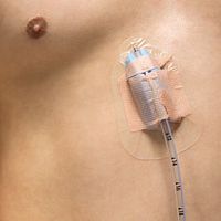 Wound drainage catheter catheter fixation Pleura-Guardwaistadhesive