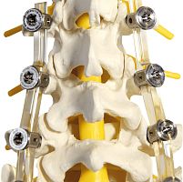 Lumbar osteosynthesis unit SpineShape System IVposterioradult