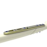 Ulna osteotomy plate HTSIS2mid-shaftlockingnon-locking