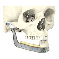 Custom-made mandibular implant non-absorbable