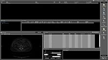 Medical software ZedViewfor implant osteotomyCTviewer