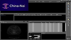 Medical software ZedViewfor implant osteotomyCTviewer