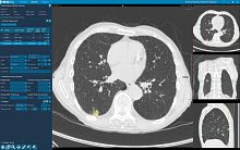 Medical software CToncologyanalysis