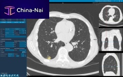 Medical software CToncologyanalysis