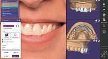 Dental implantology software Exocadtreatment planningdesignCAD