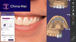 Dental implantology software Exocadtreatment planningdesignCAD