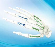 Hand phalange compression plate metacarpal jointlocking