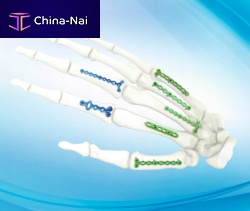 Hand phalange compression plate metacarpal jointlocking