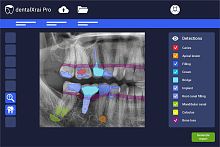 AI software dentalXrai Pro 3.0medicaldentalperiodontal