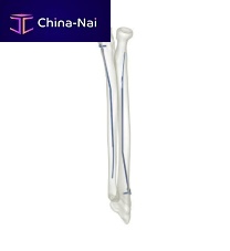 Ulnar intramedullary nail 83527 seriesradiustitanium