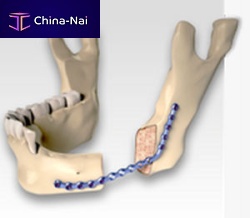 Mandible osteotomy plate CARCITEK lockingmetallic