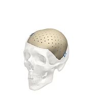 Custom-made cranial implant Cranial iD