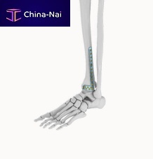 Tibia compression plate ELT010distalanterolaterallocking