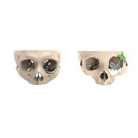 Custom-made periorbital implant non-absorbable