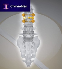 Lumbar osteosynthesis unit NEX D2posterioradult