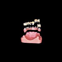 Cylindro-conical dental implant metalstraightdental laboratory