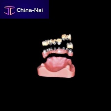 Cylindro-conical dental implant metalstraightdental laboratory