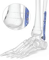 Tibia compression plate 7007-0 seriesfibulaankledistal