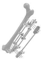 Femur external fixation system 201503tubularadult