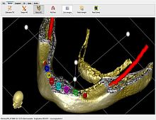 Surgical software Winmedfor dental imagingdental3D viewing