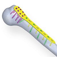 Humerus compression plate proximallockingmetallic