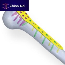 Humerus compression plate proximallockingmetallic