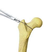 Metalic monofilament bone cerclage wiring HJ-Cerclage SS