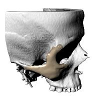 Custom-made periorbital implant non-absorbable