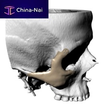 Custom-made periorbital implant non-absorbable