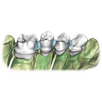 Dental software RestorationlaboratorytrainingCAD