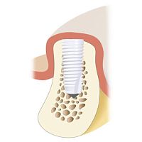 Cylindrical dental implant Z5-BLceramicinternalstraight